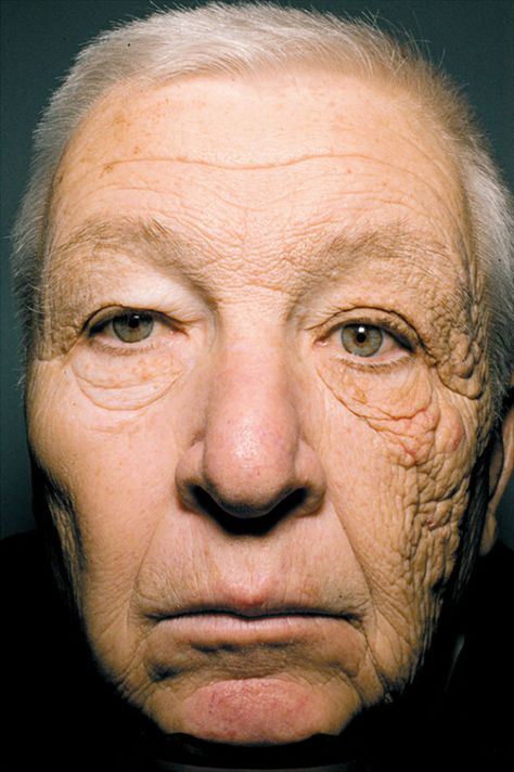 Sun Damage After 28 Years Of Driving A Delivery Truck Sun Damaged Skin, Wear Sunscreen, Sun Care, Diy Skin Care, Diy Skin, Look Younger, Truck Driver, Damaged Skin, Aging Skin