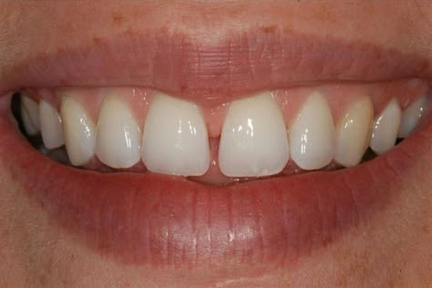 Teeth Gaps Aesthetic, Teeth Gap, Teeth Aesthetic, Teeth Pictures, Gap Teeth, Larry Johnson, Dental Art, Smile Teeth, Dental Problems