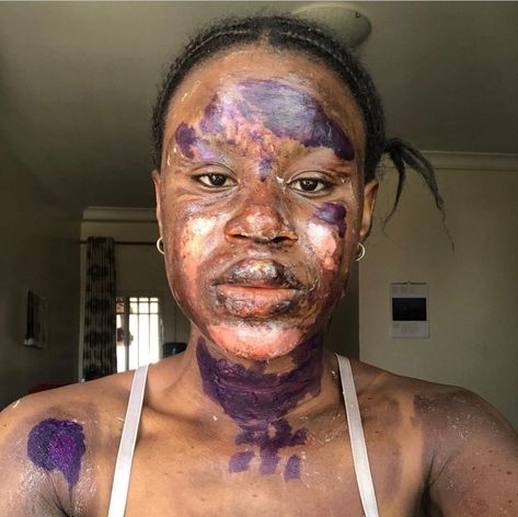 A burn survivor is lucky to have her skin back to normal just 6 months after she was burnt. The Twitter user took to the platform to share side-by-side photos of herself on November  2, 2021 and on May, 2, 2021, six months apart. She had severe burns on her face, neck  and shoulders in November 2021. Fortunately, she has now healed completely and the burns left no blemish. She added that she used honey, aleo vera and other products to restore her skin. See below…   The post Burn Survi Survivor Show, Side By Side Photo, Severe Burns, November 2, Skin Healing, In November, Side By Side, 6 Months, Carnival Face Paint