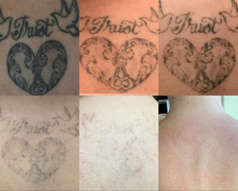 My tattoo removal experience — Beauty & the Blonde How To Remove A Tattoo At Home, Removing Tattoos At Home, Remove Tattoo At Home, Tattoo Touch Up Before And After, Diy Tattoo Removal, How To Remove Tattoo, Tattoo Removal Before And After, Removing Tattoos, Laser Tattoo Removal Healing