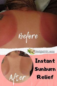 Sunburn On Face, Vinegar For Sunburn, Really Bad Sunburn, Best For Sunburn, How To Help Sunburn, Sunburn Blisters, Essential Oil For Sunburn, Get Rid Of Sunburn, Severe Sunburn