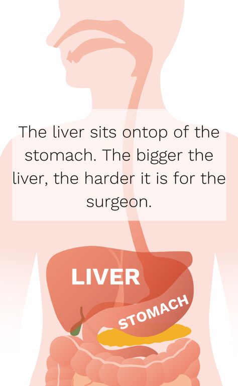 How can I tell if my liver is shrinking before my bariatric surgery? Before Bariatric Diet, Bariatric Liver Shrinking Diet, Liver Shrinking Diet, Quadrants Of The Abdomen, Healthy Liver Diet, Very Low Calorie Diet, Bariatric Sleeve, Bariatric Surgeon, Bariatric Diet