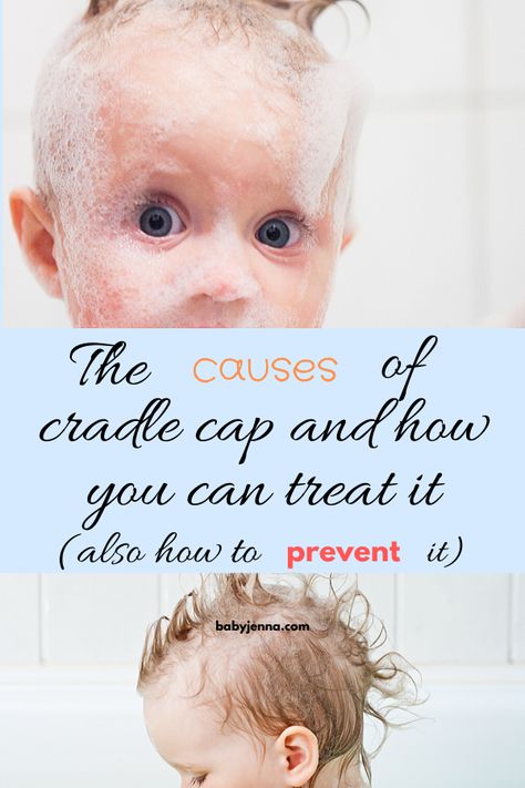 Natural Remedies For Cradle Cap, Natural Cradle Cap Remedy, How To Get Rid Of Cradle Cap, Toddler Cradle Cap, Cradle Cap Remedies, Baby Cradle Cap, Cradle Cap, Dry Skin Patches, Baby Cradle