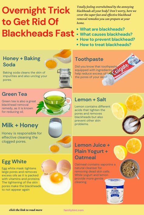 What Causes Blackheads, How To Treat Blackheads, How To Prevent Blackheads, What Are Blackheads, Remove Blackheads From Nose, Blackhead Remedies, Pimples Under The Skin, Green Tea Lemon, Blackheads On Nose