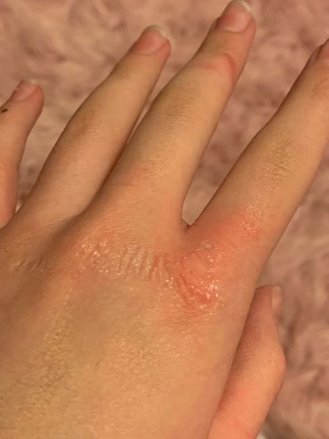 Kawaii, Burnt Hand Snapchat, Hand Burn Snapchat, Burned Hand Pic, Mind And Heart Quotes, Ramzan Video, Acrylic Nail Designs Classy, Hospital Admit Hand Pics, Eating Food Funny