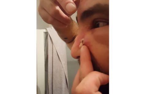 Big Pimple On The Face Explodes Pimple In Ear, Ear Pimple Poppìng Videos, Leg Pimples, Face Pimples Remedies, Big Pimple Poppìng Videos, Cystic Pimple Pop, Pimple Poppìng Videos Satisfying, Boil Popping Videos, Pimple On Eyelid