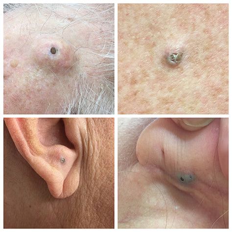 Gigantic Blackheads: What Is a Dilated Pore of Winer? – SLMD Skincare by Sandra Lee, M.D. - Dr. Pimple Popper How To Treat Pimples, Blackheads On Back, Deep Pimple, Pimple Under The Skin, Huge Pimple, Homemade Pore Strips, Honey Face Cleanser, Covering Acne, Back Acne Remedies