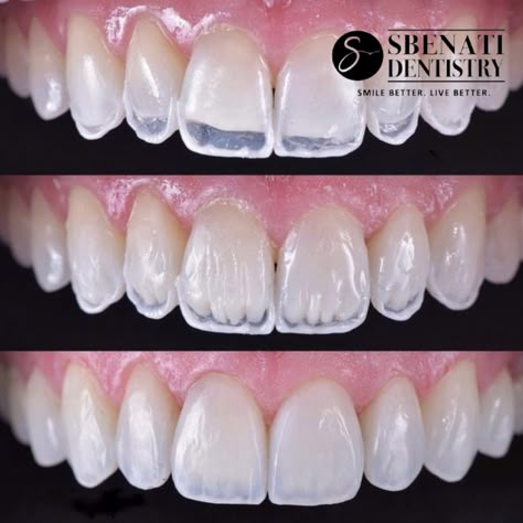 Pretty Teeth, Dental Videos, Veneers Teeth, Dental Anatomy, Aesthetic Dentistry, Dental Fillings, Beautiful Teeth, Dental Braces, Perfect Teeth