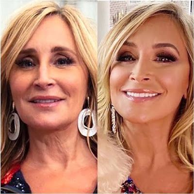 Thread Lift Face, Neck Lift Surgery, Facelift Before And After, Sonja Morgan, Facial Procedure, Plastic Surgery Photos, Face Lift Surgery, Plastic Surgery Procedures, Facial Plastic Surgery