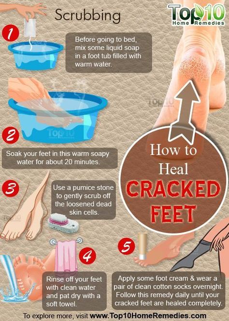 Cracked Heel Remedies, Top 10 Home Remedies, Diy Pedicure, Cracked Heels, Healthy Routine, Manicure Y Pedicure, Diy Skin Care, Diy Skin, Beauty Skin Care Routine