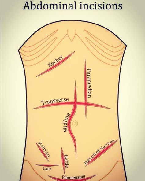 Abdominal Incisions in GENERAL SURGER Abdominal Incisions, Nursing School Pharmacology, Surgical Technologist Student, Nursing School Studying Cheat Sheets, Anatomy Coloring, Medical Terminology Study, Perioperative Nursing, Medical Surgery, Surgical Technician