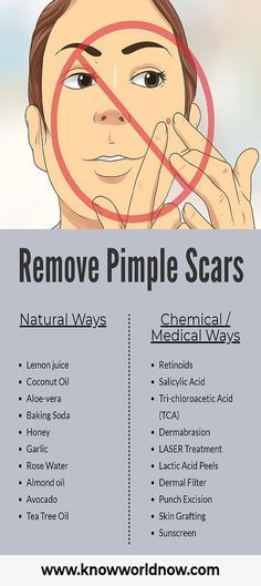 Pimple Scar Removal, Tea Tree Oil Skin, To Remove Pimples, Remove Pimples, Pimple Scars, Skin Grafting, How To Remove Pimples, Salicylic Acid, Tea Tree Oil