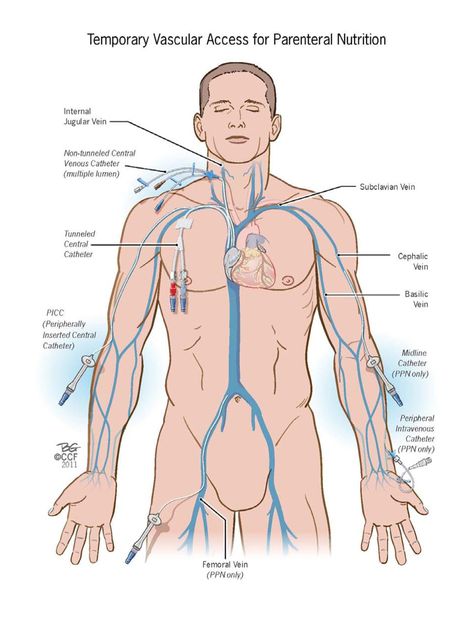 Venous Access for PN // ACG Nursing Iv, Parenteral Nutrition, Nursing Board, Nursing Mnemonics, Nursing School Survival, Nurse Rock, Nursing School Studying, Iv Therapy, Nursing Tips