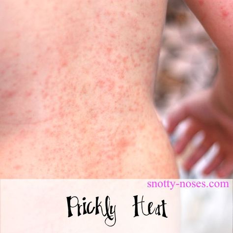 Prickly Heat Rash in Children by a pediatrician Remedies For Heat Rash, Natural Rash Remedies, Heat Rash On Face, Treating Heat Rash, Skin Rash Remedies, Baby Heat Rash, Heat Rash Remedy, Prickly Heat Rash, Home Remedies For Rashes