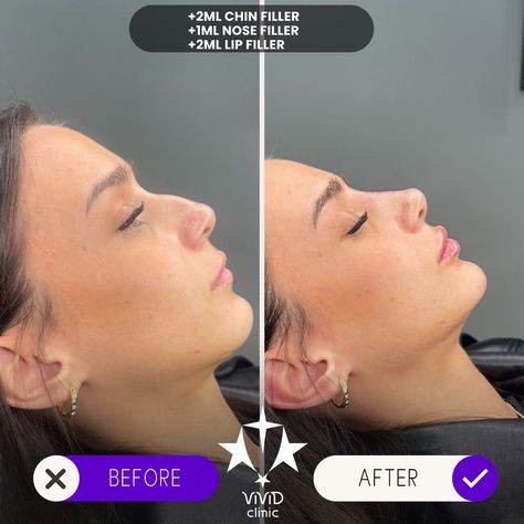 💉✨ Sculpt and define your face with Jawline Filler at Vivid Clinic! Check out this stunning Client Transformation—perfectly contoured, sharper jawline for a more defined and balanced appearance. 💎 ✅ Enhances facial definition ✅ Non-surgical with immediate results ✅ Long-lasting, natural-looking transformation 💬 Want to achieve a similar look? Book your free consultation today and take the first step toward a more sculpted you! 📍Located in Istanbul, Turkey 🌐 vividclinic.net 📞 🇺🇸 +90 545 742... Facial Definition, Sharper Jawline, Jawline Filler, Nose Fillers, Chin Filler, Lip Fillers, Istanbul Turkey, Take The First Step, Free Consultation