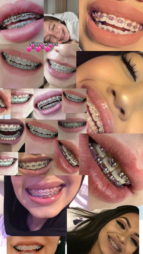 Perfect Teeth Braces, Dental Braces Colors, Pink Braces, Cute Braces Colors, Pretty Teeth, Braces Tips, Grillz Teeth, Getting Braces, Braces Girls