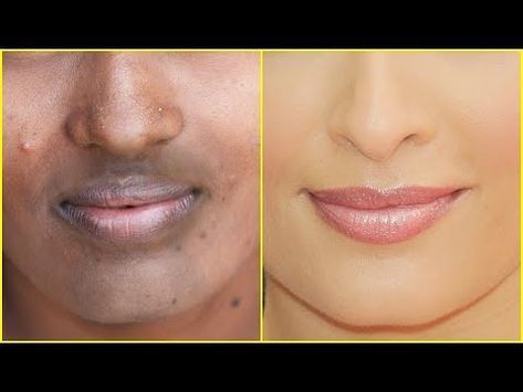 How To Remove Black Mark From Face, Face Darkness Removal, Dark Chin Remedy, How To Remove Black Spots On Face, Face Black Spot Removal, How To Cover Dark Spots On Face, Remove Black Spots On Face, How To Remove Dark Spots On Face, White Patches On Face