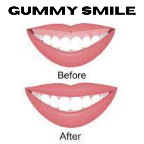 If you are bothered by your gummy smile and want to look into ways to reduce the appearance of gum tissue, schedule a consultation and talk to a reputable doctor in your area now. Gummy Smile, When You Smile, Trends 2023, Dental Office, Night Routine, Dental Care, You Smile, Gum, Health