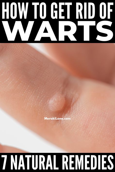 Warts On Hands, Home Remedies For Warts, Remove Skin Tags Naturally, Warts Remedy, Get Rid Of Warts, Skin Natural Remedies, Cold Sores Remedies, Natural Sleep Remedies, Natural Cold Remedies