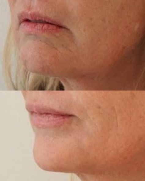 Injections for DAO Muscle | Downturned mouth - Best Clinic Sydney for Dermal Fillers Downturned Mouth, Chin Wrinkles, Mild Acne, Marionette Lines, Fractional Laser, Numbing Cream, Cosmetic Clinic, Dermal Fillers, Muscle Relaxer