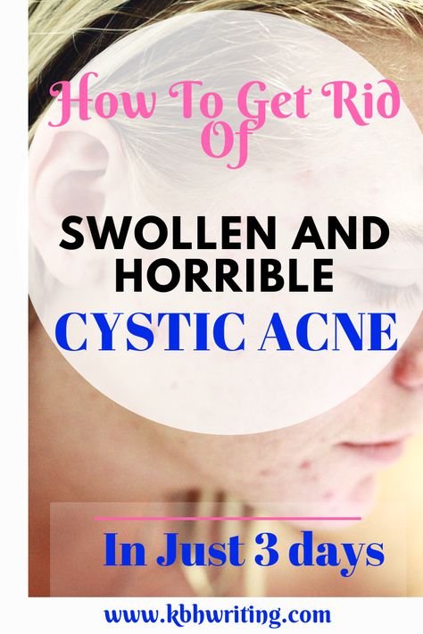 Get Rid Of Cystic Acne, Cystic Acne On Chin, Treating Cystic Acne, Cystic Acne Remedies, Cystic Pimple, Forehead Acne, Pimples Remedies, Natural Acne Remedies, Home Remedies For Acne