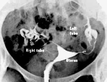 Normal HSG.  Hysterosalpingogram #fertility Hsg Test, Ivf Implantation, Getting Pregnant Tips, Baby Dust, Nuclear Medicine, Female Reproductive System, Fallopian Tubes, Medical Coding, Reproductive System