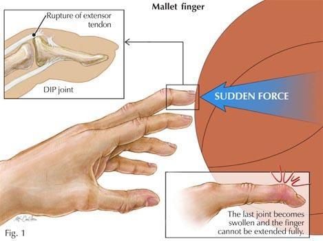 Mallet finger - I just feel dumber every time I see somebody else notice it. Jammed Finger, Mallet Finger, Finger Injury, Physical Disabilities, Medical Terminology, Hand Therapy, Therapy Tools, Occupational Therapy, Health Facts