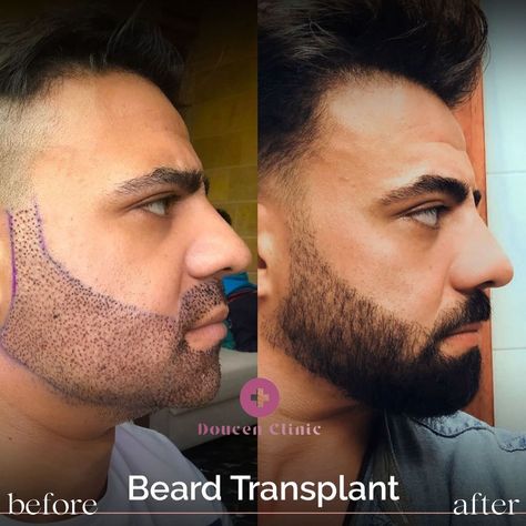 Upgrade your look with our beard transplant service. Say goodbye to patchy spots and hello to a full, luscious beard. Embrace a new level of confidence and style. Book your transformation today! 👨💪 #BeardTransplant Beard Transplant, Upgrade Your Look, Say Goodbye, Confidence, Books, Quick Saves, Instagram