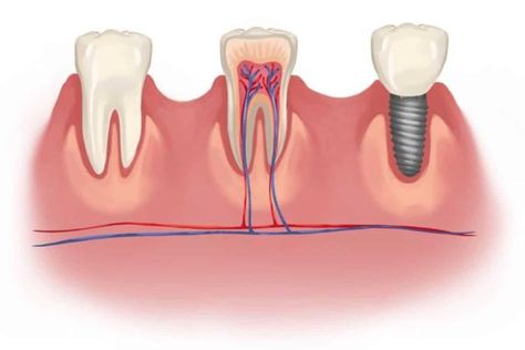 Dental Implants Austin TX Clear Choice Dental Implants, Straumann Dental Implants, Subglandular Implant, Benefits Of Dental Implants, Implant Dentist, Dental Implant Surgery, Implant Dentistry, Dental Implant, Tips For Success