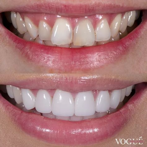 Before and After Smile Makeovers - Vogue Dental Studios Veneer Teeth, Teeth Makeover, Natural Veneers, Pretty Teeth, Veneers Teeth, Beautiful Teeth, Porcelain Veneers, Teeth Shape, Perfect Teeth