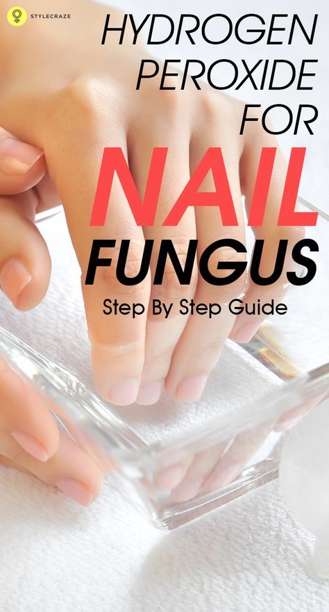 Nail Remedies, Natural Antifungal, Fingernail Fungus, Toenail Fungus Remedies, Nail Fungus Remedy, Nail Infection, Fungal Nail, Toenail Fungus, Fungal Infection