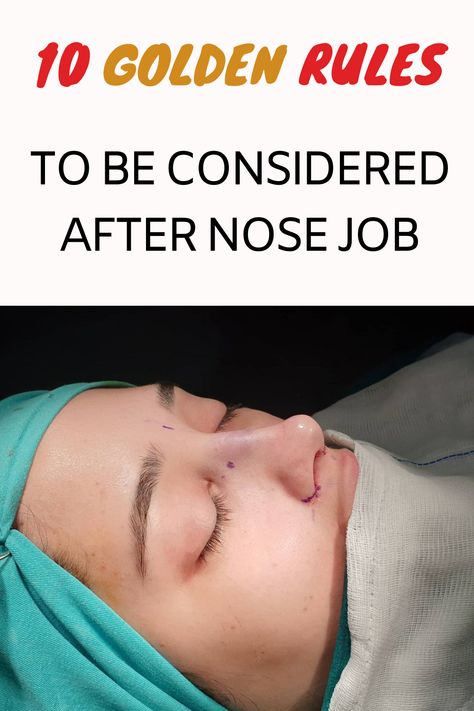 Rhinoplasty (nose job) provides a beautiful nose that is compatible with the face and aesthetically pleasing. In rhinoplasty, it is very important for the patient to fully trust her doctor and decide together on the procedure to be performed. In rhinoplasty, the basic principle is to obtain the desired shape by preserving the basic functions of the nose. If the patient needs it, many other procedures can be performed during rhinoplasty surgery. Rhinoplasty Swelling Progression, Rhinoplasty Recovery Tips, Nose Inspiration Rhinoplasty, Broken Nose Surgery, Bulbous Nose Rhinoplasty Before After, Rhinoplasty Recovery Timeline, Nose Job Recovery, Rhinoplasty Recovery, Nose Surgery Rhinoplasty