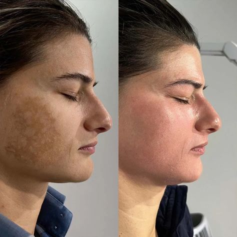 Chemical Peel Aesthetic, Chemical Peel Before And After, Best Chemical Peel, Jaw Reduction Surgery, Peeling Face, Chemical Peeling, Plastic Surgery Fail, Plastic Surgery Gone Wrong, Face Surgery