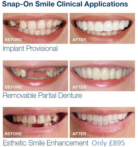 We offer #SnapOnSmile solutions to our patients at all of our Synergy Dental Clinics Teeth Products, Snap On Smile, Teeth Covers, Pretty Teeth, Missing Tooth, Veneers Teeth, Partial Dentures, Fake Teeth, Teeth Braces