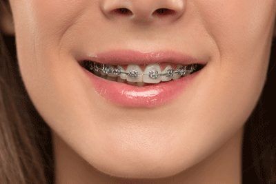 Tooth Bridge, Braces Dentist, Braces Cost, Teeth Whitening Procedure, Braces Tips, Traditional Braces, Get Whiter Teeth, Discolored Teeth, Crooked Teeth