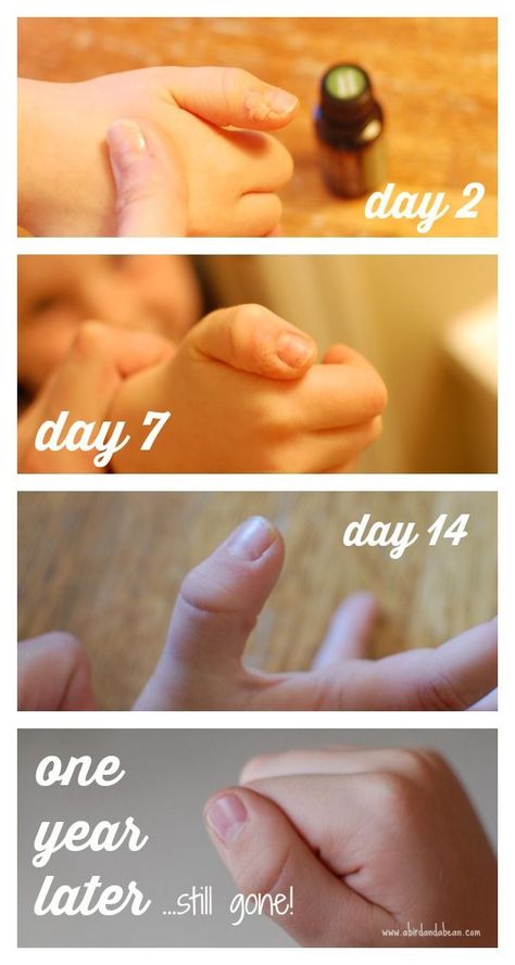 Natural, Effective Wart Removal - in just 7 days you can remove warts and keep them off without chemicals.  AMAZING results! Warts On Hands, Warts On Face, Skin Wars, Remove Warts, Get Rid Of Warts, Cold Sores Remedies, Natural Sleep Remedies, Natural Cold Remedies, Cold Home Remedies