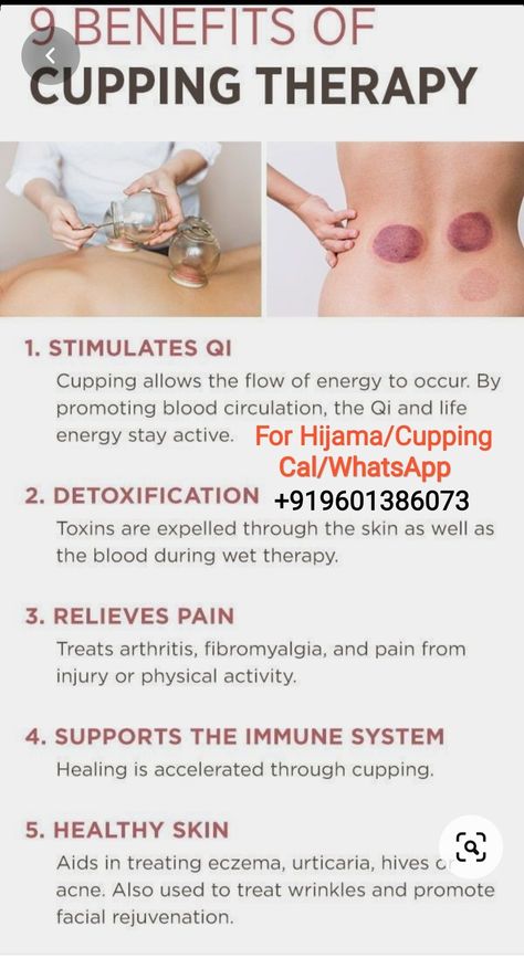 Fire Cupping Therapy, Back Cupping Therapy, Cupping Marks Meaning, Cupping Therapy Placement Chart, Cupping Before And After, Dry Cupping Therapy Chart, Hijama Cupping Therapy Benefits, Benefits Of Cupping Therapy, Cupping Therapy Chart Trigger Points