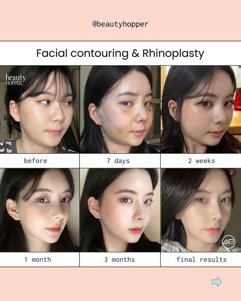 Changing your facial shape and proportion can be an extremely powerful tool to amplifying your beauty✨ For the above procedures, we recommend you to stay a minimum of 2 weeks in Korea. 👉🏻Whether you are seeking a subtle refinement or a more dramatic transformation, we can guide you to the best surgeon capable of achieving the aesthetic you desire. We’re here to help you have a safe and successful makeover in Korea. Contact us for a free consultation ⬇️⬇️⬇️ 💌: contact@beautyhopper.com 📲... Rhinoplasty Recovery, Plastic Surgery Korea, Rhinoplasty Before And After, Beauty Procedures, Fat Grafting, Facial Contouring, Celebrity Plastic Surgery, Botox Fillers, Medical Tourism