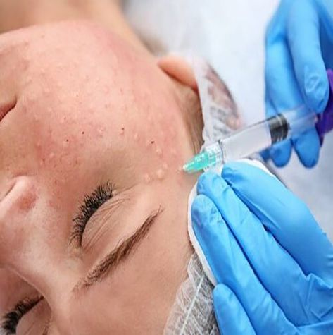 ● Delivery of Hyaluronic acid (HA) into the superficial and middle layer of the skin can be done in various ways, including micro-injections, microneedling pens, mesoguns and mesostamping. ● Bioreviatalization - involves micro-injections of Hyaluronic acid (HA) and nutrients into superficial and middle layer of skin. #vidaskinbeautycenter #skinbeautycenter #skincare #skincareroutine #agelessbyabovian #beauty #makeup #skin #lipocavitation #biorevitalization Aesthetic Dermatology, Skin Spots, Reconstructive Surgery, Beauty Center, How To Look Handsome, Deep Wrinkles, Layers Of Skin, Health Magazine, Improve Skin Elasticity