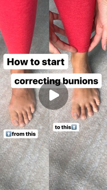 Heidi • Barefoot Functional Movement on Instagram: "Grab The Bunion Protocols with Beginners Foot Strength at www.thatbarefootcoach.com!  It would be impossible for me to cover all necessary nuances and exercises in 90 seconds. The purpose of this exercise and example is to demonstrate that bunions don’t occur in silo.  This is why Beginners Foot Strength is a necessary part of the process. You need to…  👣address your foot function as a whole 👣get out of the environment that contributed to the bunions (tapered toe shoes) 👣dedicate yourself to the process and journey, because there is no easy or overnight fix  For more in depth info check out my blogs on my website. . . . . #Foothealthawareness #barefootworkout #footpainrelief #barefooting #minimalistshoes #barefoottraining #strongfeet # Bunionette Taping, Seronegative Ra, Hammer Toe Correction, Workout Routine Plan, Toe Exercises, Ankle Exercises, Functional Movement, Chin Exercises, Toe Straightener