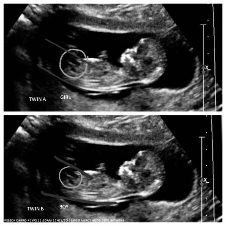 Twins Ultrasound 6 Weeks, 13 Week Ultrasound, Ultrasound Student, Twins Ultrasound, Sonography Student, 3d Ultrasound, Pregnancy Ultrasound, Ultrasound Technician, Baby Ultrasound