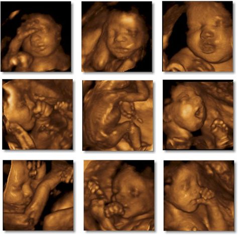 . 17 Weeks Pregnant Ultrasound, 4d Ultrasound Pictures, 3d Ultrasound Pictures, Anterior Placenta, 19 Weeks Pregnant, 16 Weeks Pregnant, 3d Ultrasound, 4d Ultrasound, Castlevania Wallpaper