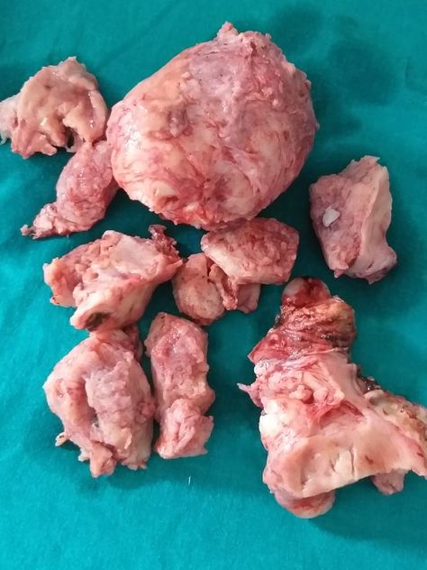 1.8 kg uterine fibroid removed by Hysterectomy Huge fibroid about 1.5 kg removed by Hysterectomy surgery by our team.  #fibroidremove #HysterectomySurgery #MotherhoodHospital Fibroid Surgery, Surgery, Stuffed Mushrooms, Quick Saves