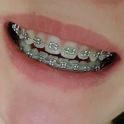 Perfect Teeth Braces, Pink Braces, Smile Tips, Silver Braces, Braces Smile, Teeth Aesthetic, Cute Braces Colors, Pretty Teeth, Braces Tips