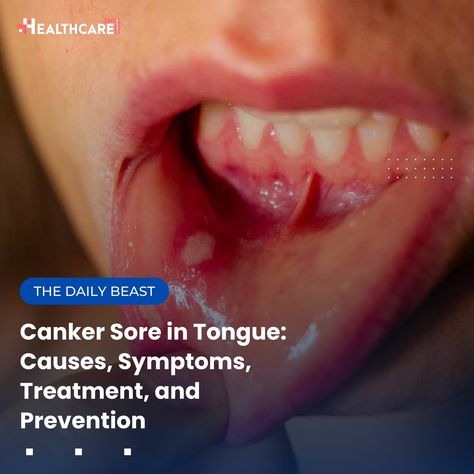 Struggling with canker sores? You’re not alone! These painful mouth ulcers can disrupt your daily life, but knowledge is power! Take charge: Learn the causes, symptoms, and prevention strategies in our latest article. Don’t let discomfort hold you back! #CankerSore #OralHealth #HealthyLiving #HealthcareTips #PainRelief #HealthAwareness #MouthUlcers #TongueCare #WellnessJourney #SelfCare #HealthyMouth #PreventiveCare #Nutrition #StressManagement #HealthyHabits #HealthEducation #DailyHealth #... Canker Sore, Sore Throat, Take Charge, Knowledge Is Power, Health Awareness, Health Education, Hold You, Oral Health, Healthy Habits