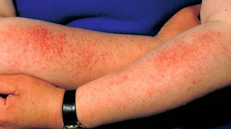 Sun Poisoning Rash, Heat Rash Remedy, Home Remedies For Rashes, Allergy Rash, Severe Sunburn, Armpit Rash, Rashes Remedies, Sun Allergy, Itchy Rash