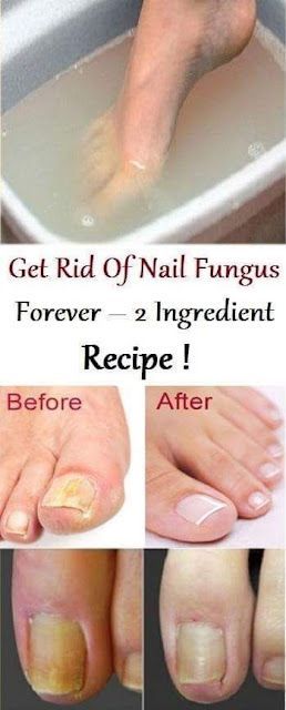 A fungal nail occurs when a fungus attacks a toenail fingernail or the skin under the nail. Any part of the body can be affected by fungal infection 2 Ingredient Recipes, Weight Watchers Snacks, Weight Watchers Desserts, Natural Healing Remedies, Diy Remedies, Toenail Fungus, 2 Ingredient, Fungal Infection, Natural Therapy