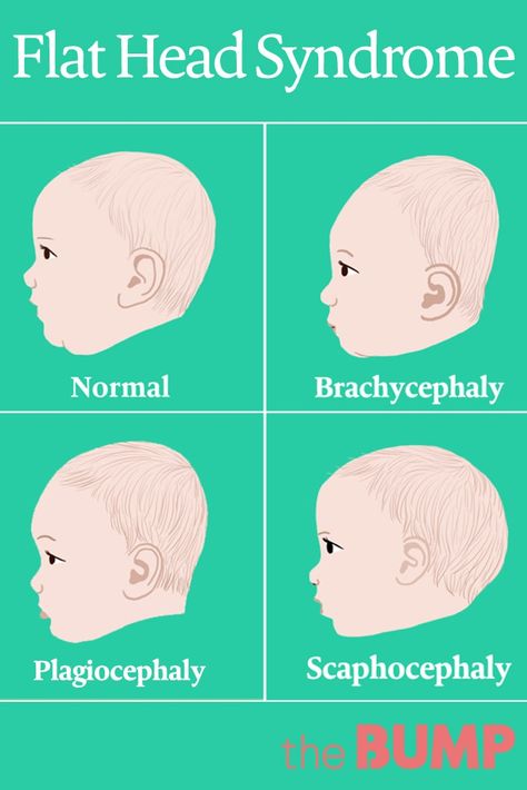 Plagiocephaly has become more common over the last few decades. Find out what causes flat head syndrome and how to prevent baby from getting it. Baby Acne Remedy, Baby Head Shape, Flat Head Baby, Orthotics And Prosthetics, Flat Head Syndrome, Swiss Dot Blouse, Baby Helmet, Raising Twins, Breastfeeding Positions