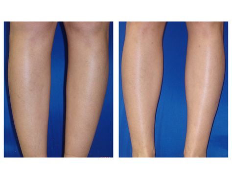 Calves & Ankles Liposuction by Dr. William Hall Before and After photos. Call us 480-946-7100 or go to phoenixliposuction.com After Photos, Phoenix, Art