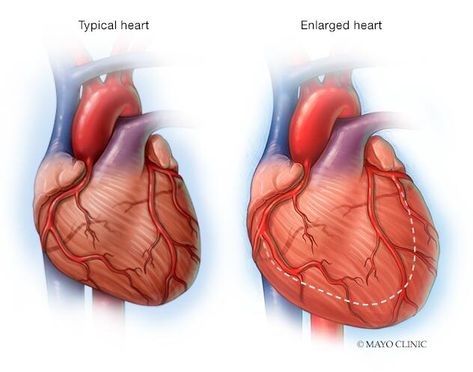 Enlarged Heart Symptoms, Heart Symptoms, Enlarged Heart, Blood Pressure Medicine, Gut Issues, Health Heart, Healthy Facts, Heart Muscle, The Healer